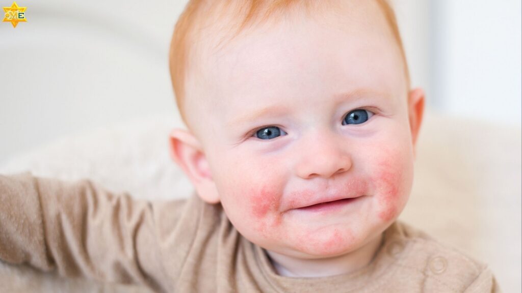 Bé sơ sinh bị viêm da cơ địa