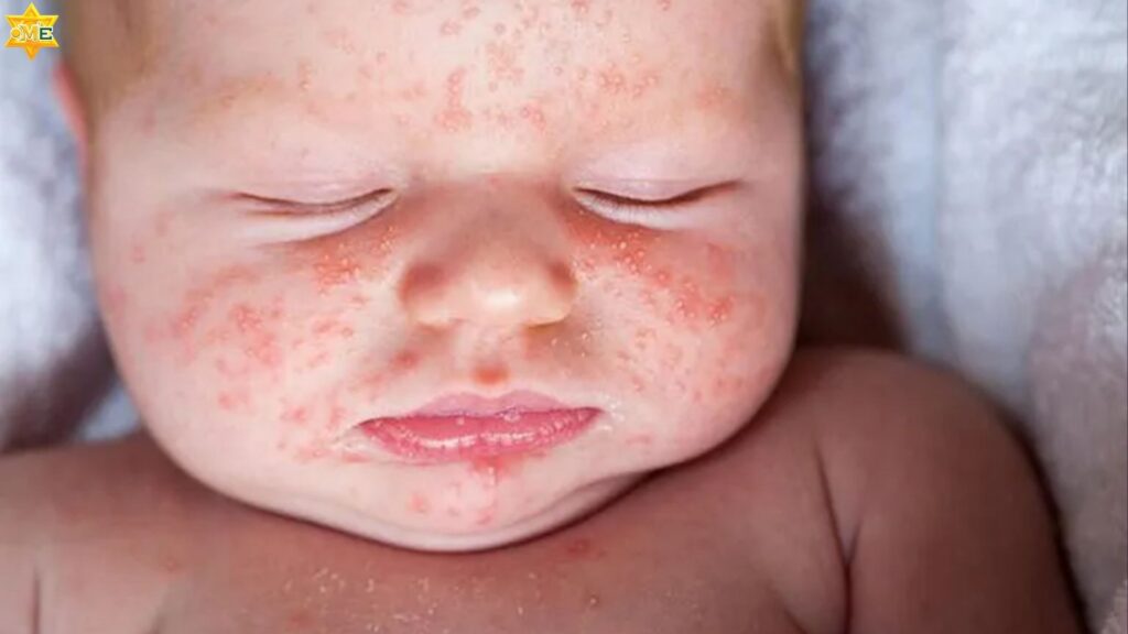 Viêm da mặt ở bé sơ sinh