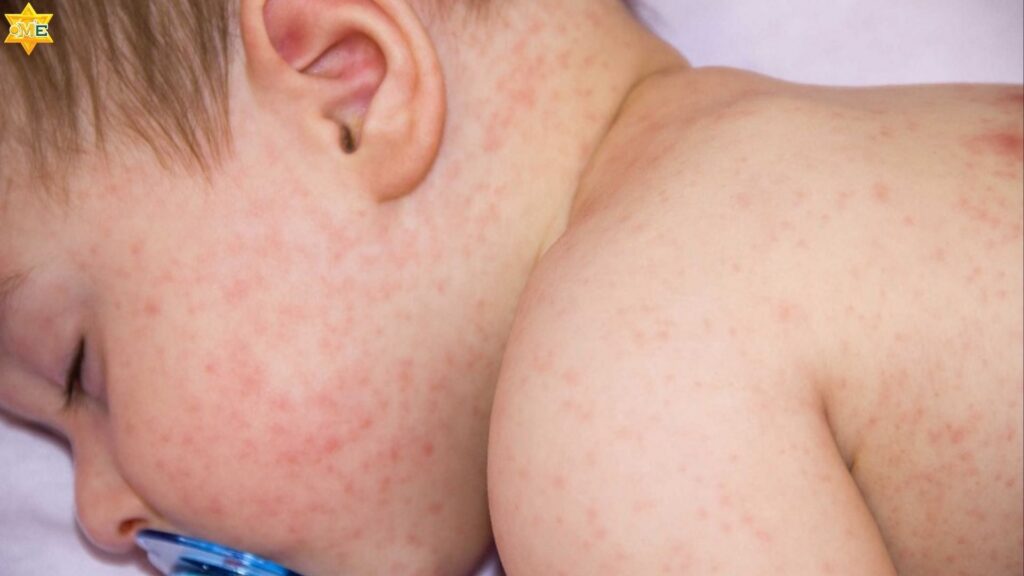 Viêm da thể tạng khiến bé khó chịu