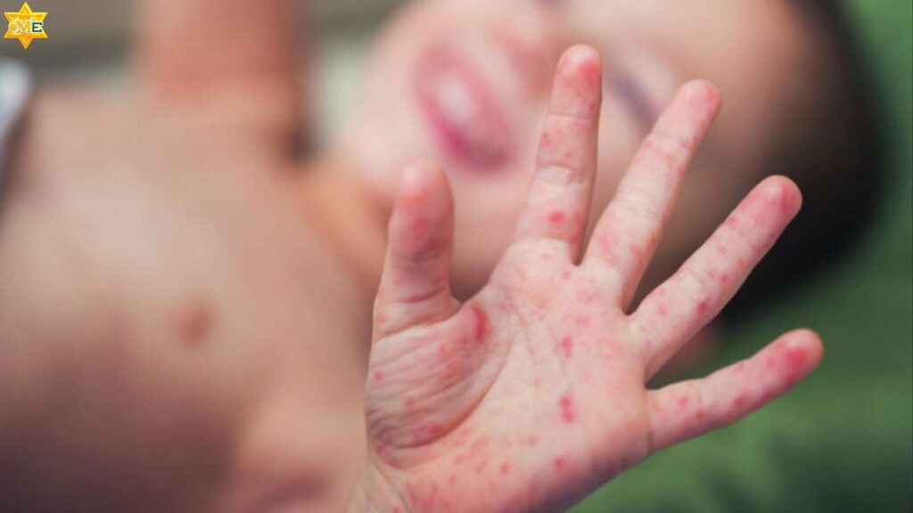 Bé sơ sinh bị viêm da tiếp xúc