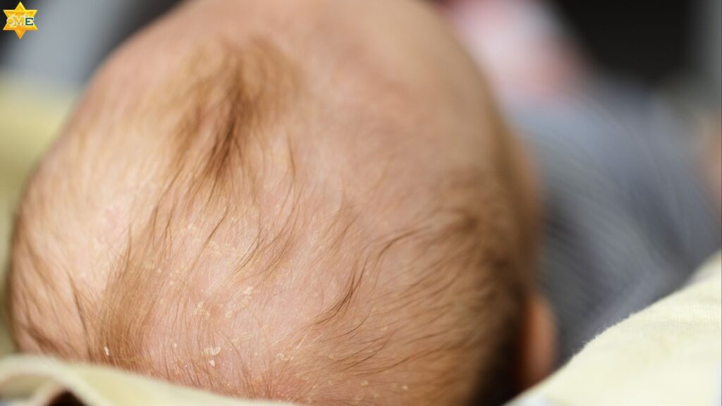 Bé sơ sinh bị viêm da tiết bã