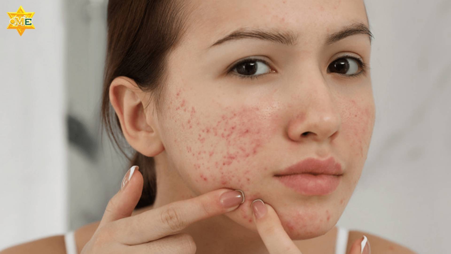 chế độ dinh dưỡng cho da mụn