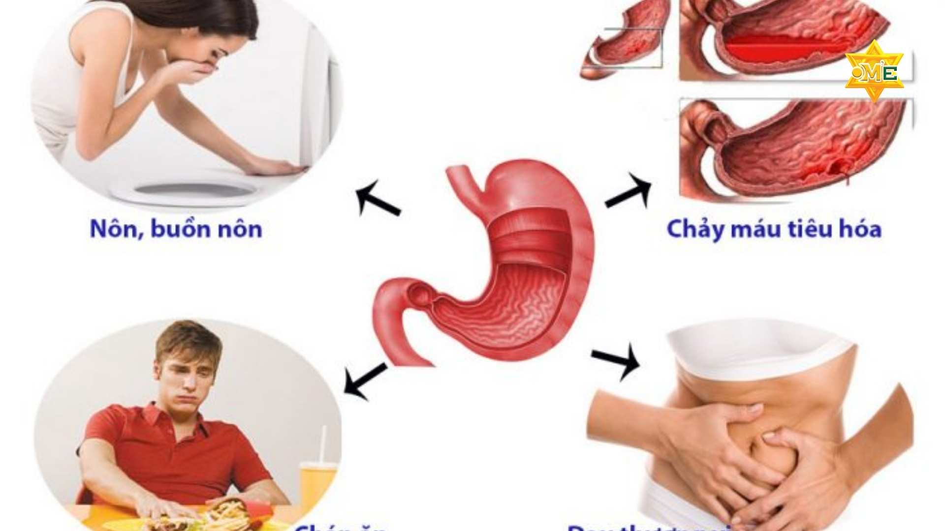 Nguyên Nhân Dẫn Đến Đau Dạ Dày