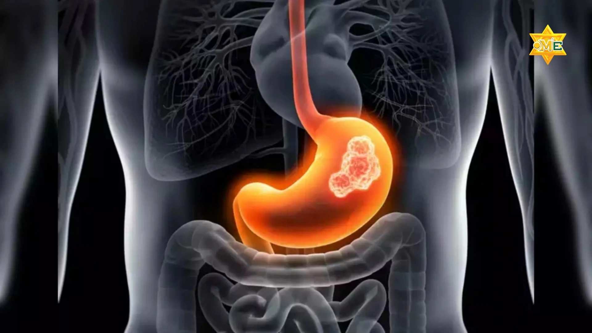 Nguyên Nhân Dẫn Đến Đau Dạ Dày