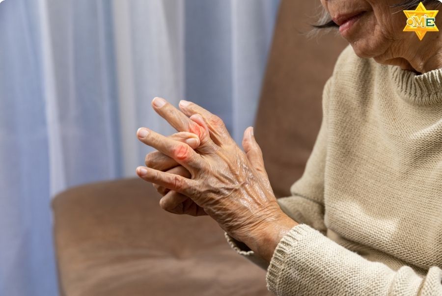 Bệnh gút sống được bao lâu?