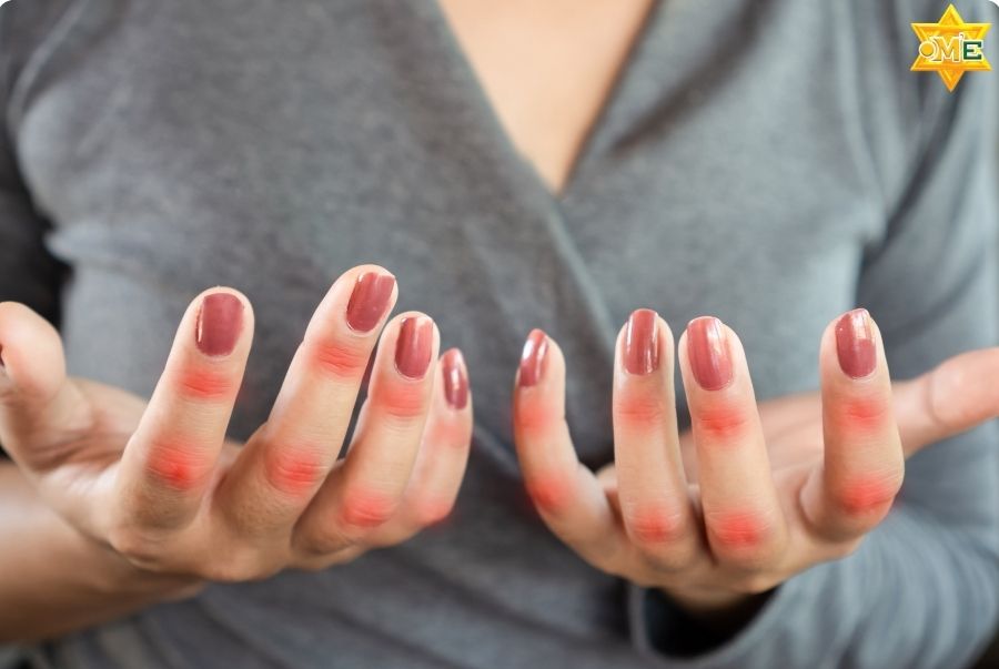 Các biến chứng bệnh gout