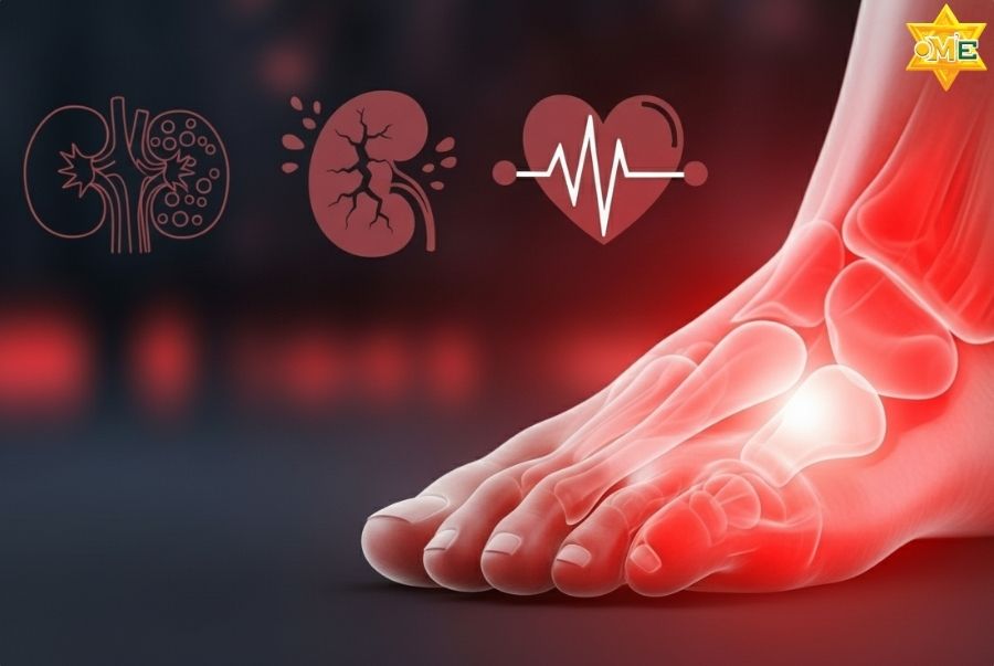 Nguyên nhân dẫn bệnh Gout