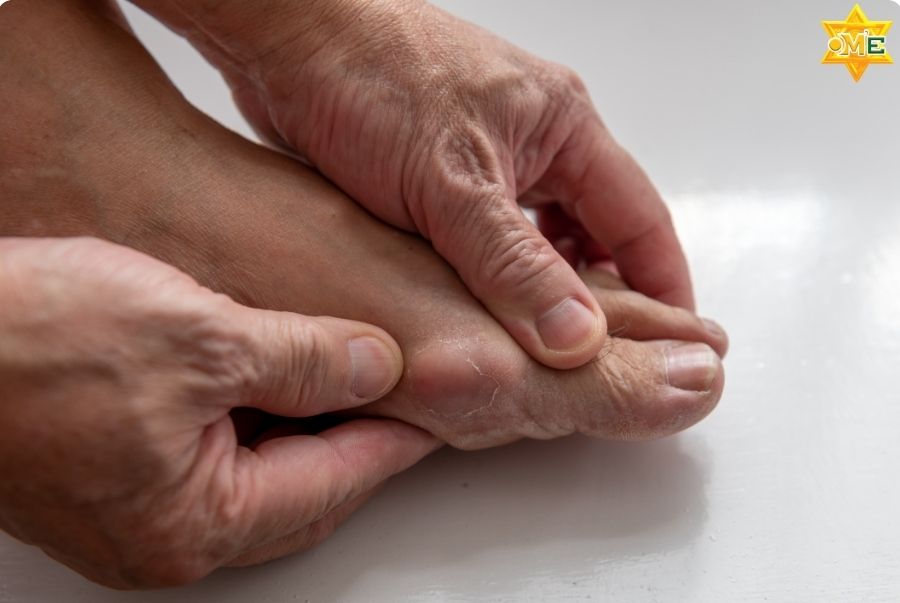 Dấu hiệu nhận biết sớm bệnh gout