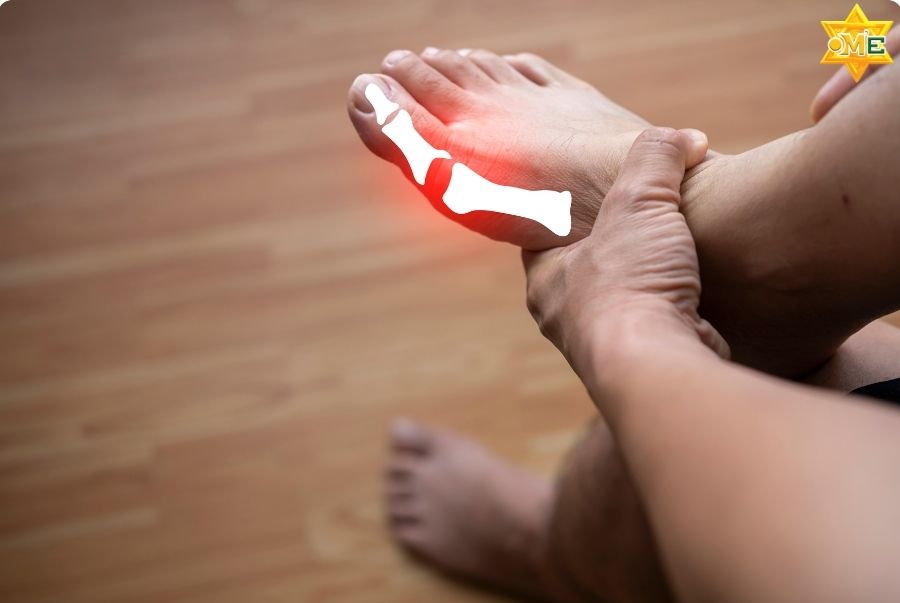 Làm sao nhận biết dấu hiệu bị gout và điều trị hiệu quả?