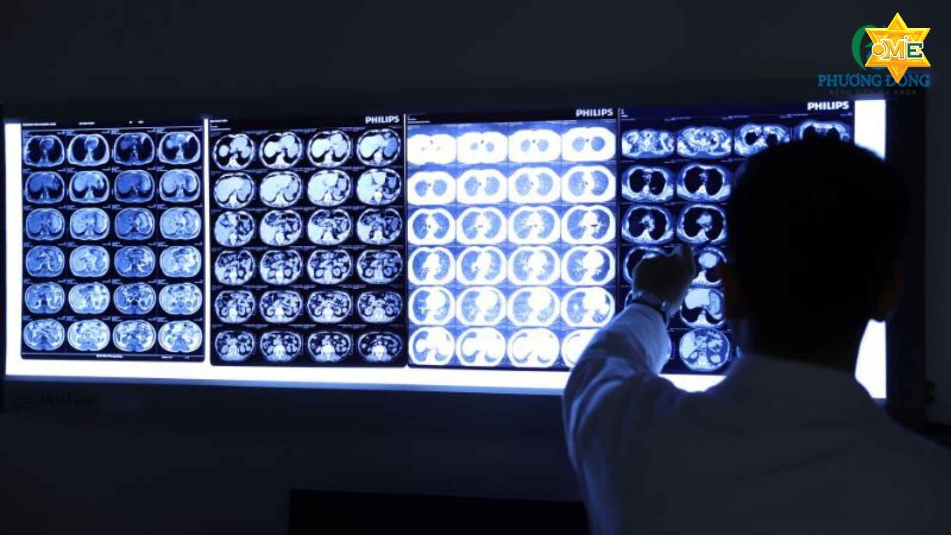 rối loạn phát triển lan tỏa