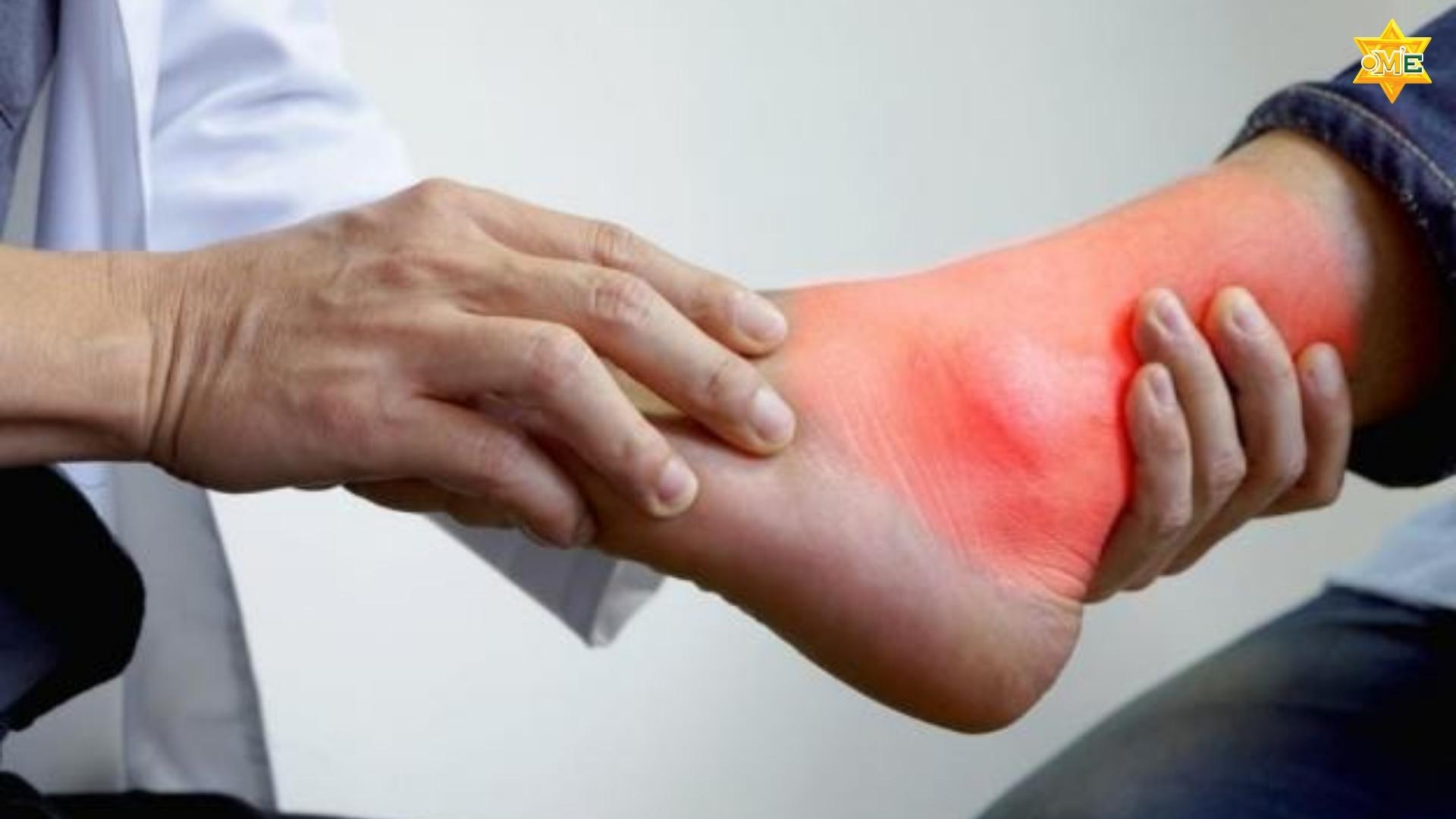 Hướng Dẫn Xoa Bóp Chữa Bệnh Gout Chuẩn Y Học Cổ Truyền