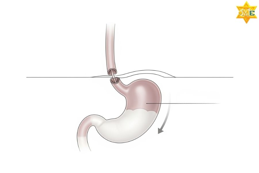 Hiểu nhanh về cơn đau dạ dày