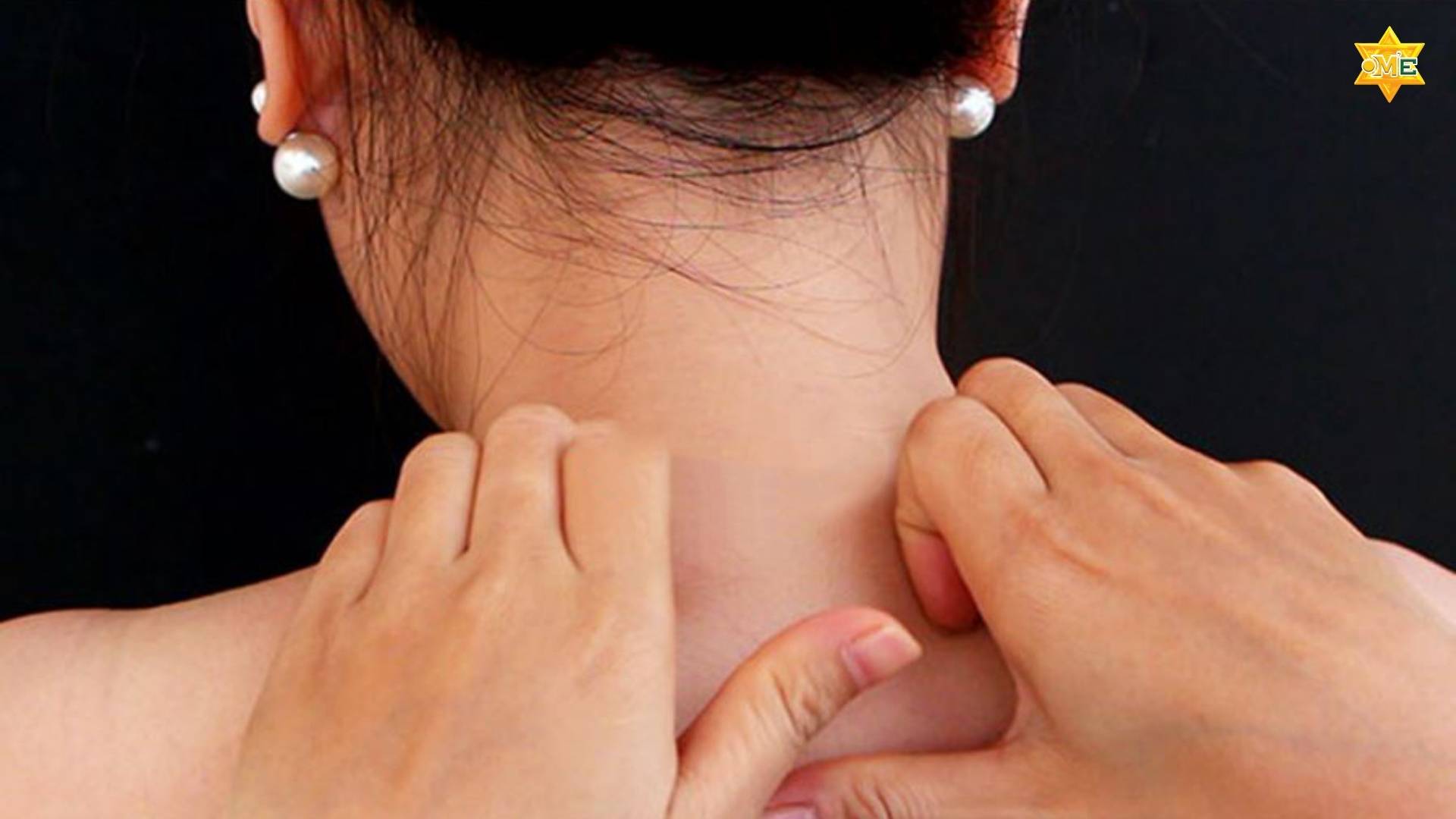 Cách xác định huyệt trên cổ và các huyệt vùng cổ gáy chuẩn xác