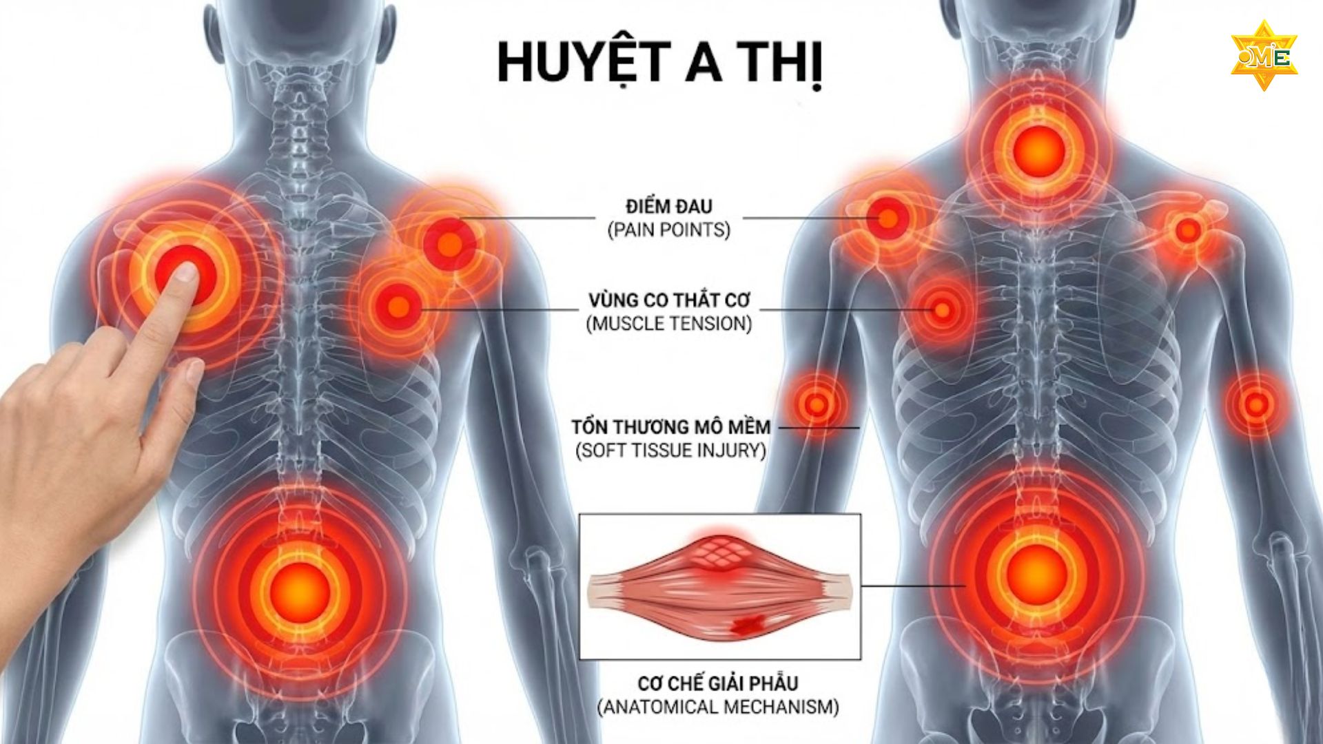 Cách xác định huyệt a thị