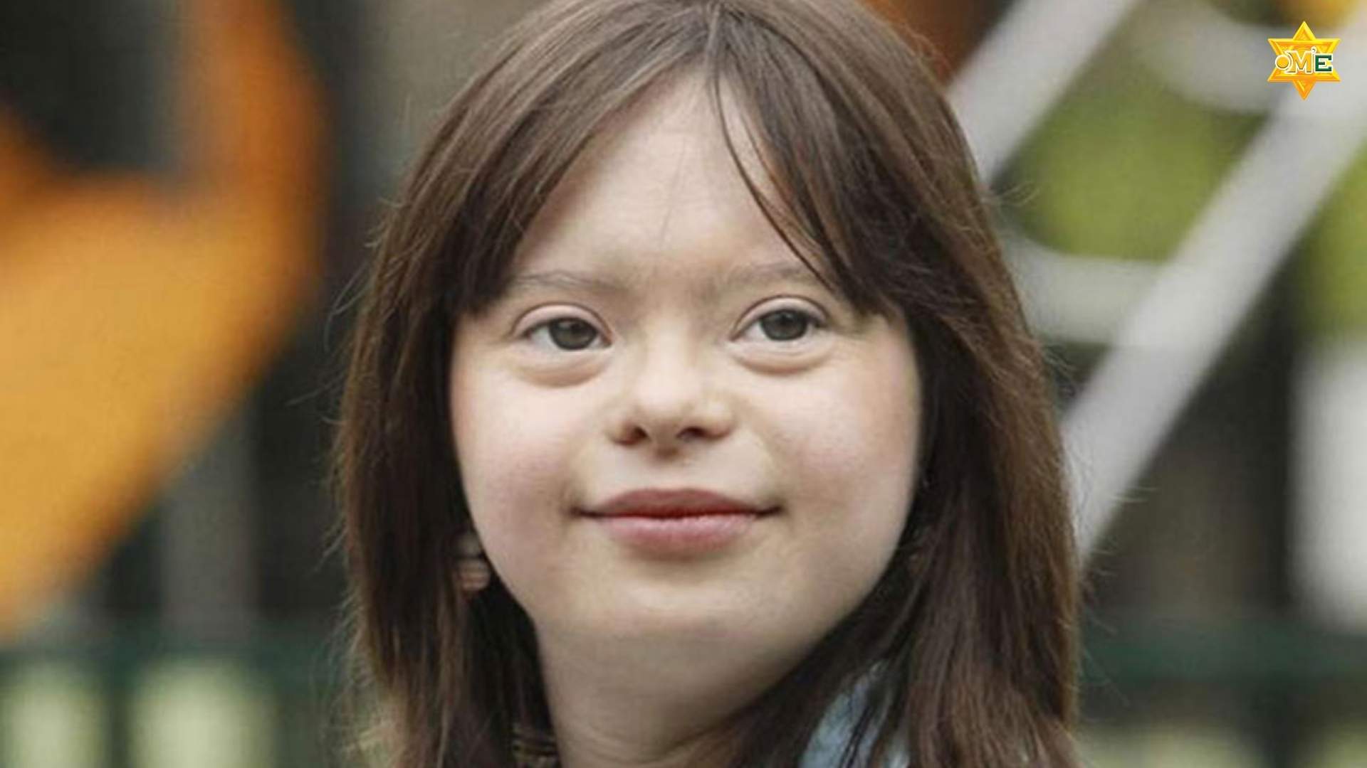 Hội chứng Down là bệnh gì