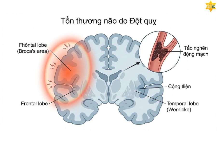 Tại sao bị rối loạn ngôn ngữ? 